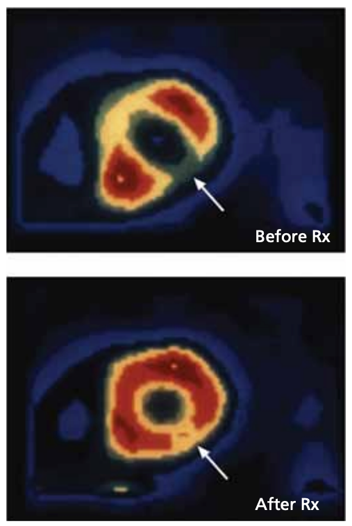 Restoration of myocardial perfusion