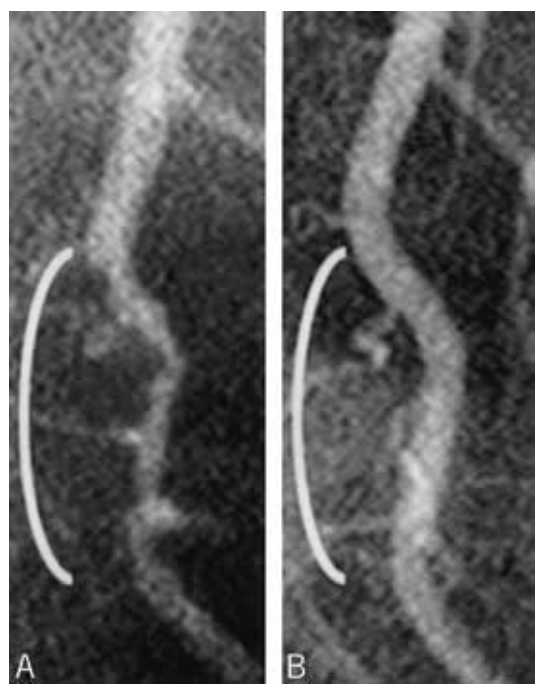 Reversal of coronary artery disease